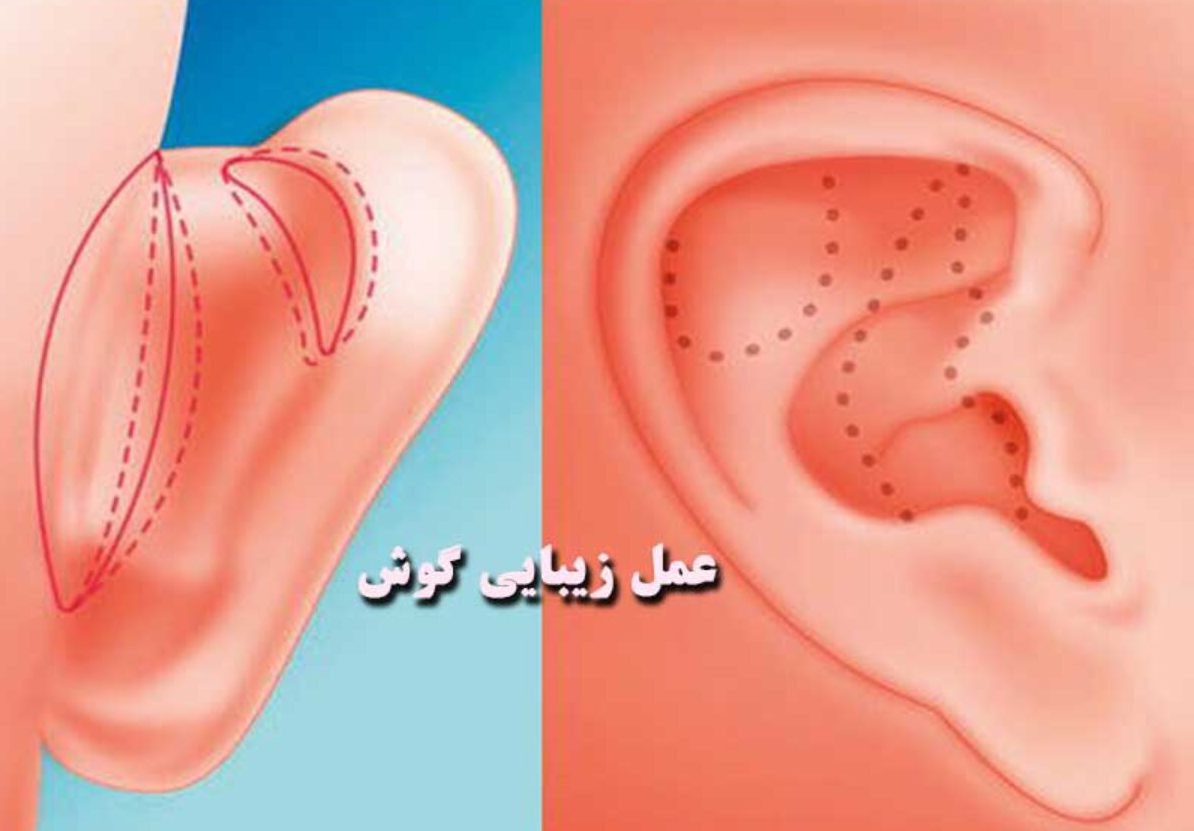 جراحی زیبایی گوش در استانبول