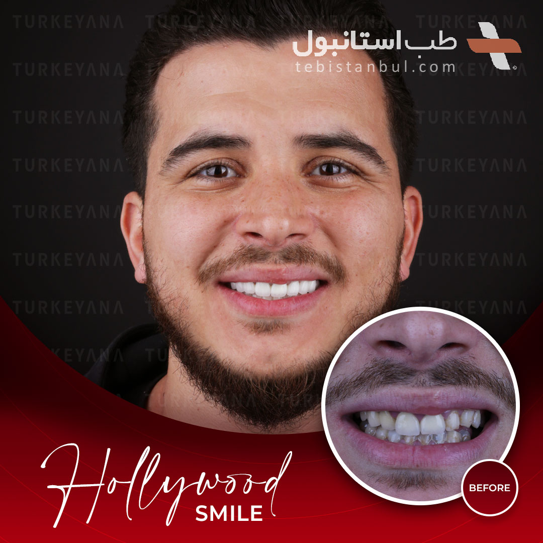 نمونه عکس دندانپزشکی زیبایی در استانبول