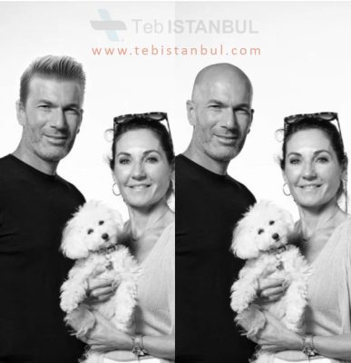 زیدان قبل و بعد از کاشت مو در استانبول