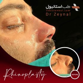 جراحی بینی ترکیه - دکتر زینال
