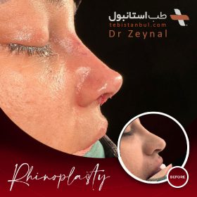 جراحی بینی ترکیه - دکتر زینال