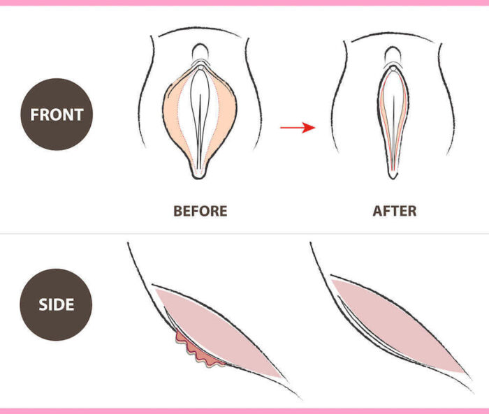 جراحی زیبایی واژن در استانبول